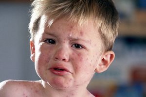 Как проявляется аллергия на лице?