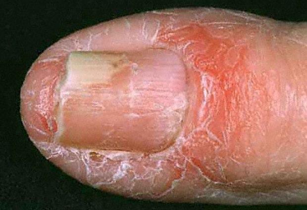Экзема ногтей. Как удержать болезнь под контролем