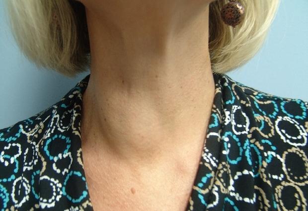 Узлы в щитовидной железе: причины образования, симптомы, осложнения