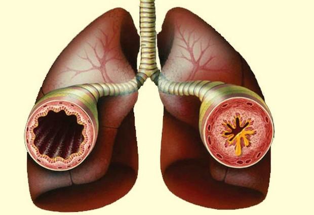 Бронхиальная астма: методы народного лечения