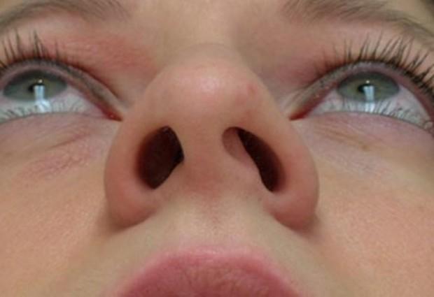 Искривленная перегородка в носу – угроза здоровью?