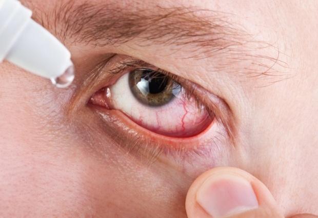 Хламидиоз глаз: причины, симптомы, пути заражения