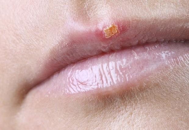 «Простуда» на губах: лечение противовирусное, симптоматическое