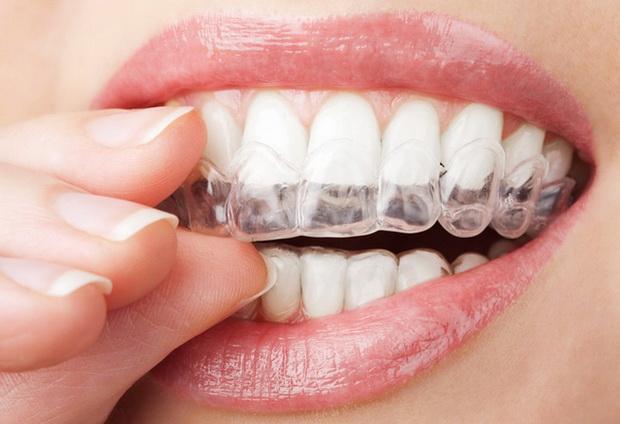 Микроабразия эмали зубов – прогрессивное отбеливание