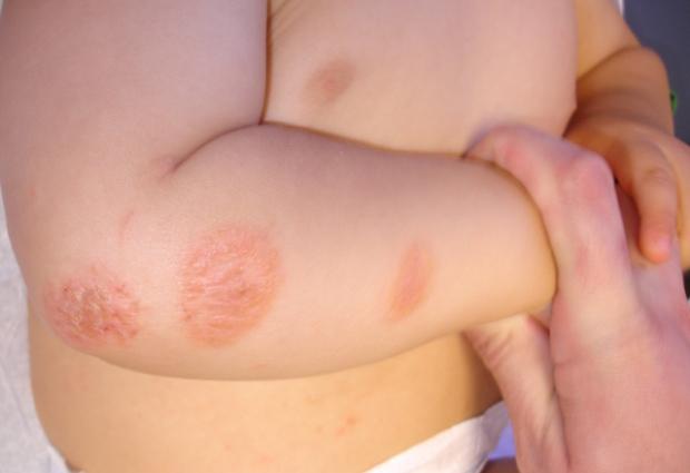 Экзема, дерматит… Что мы знаем о болезнях кожи?