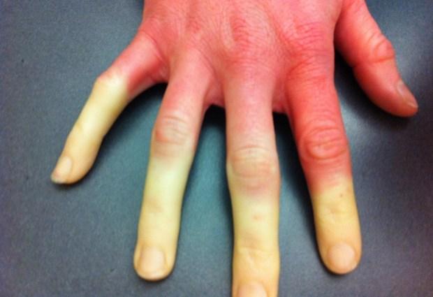 Покалывание пальцев рук: туннельный и кубитальный синдром