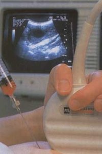 Биопсия хориона — важное исследование во время беременности