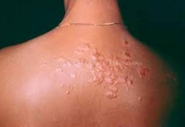 Саркоидоз кожи: симптомы, лечение