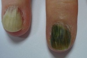 Почему зеленеют ногти?