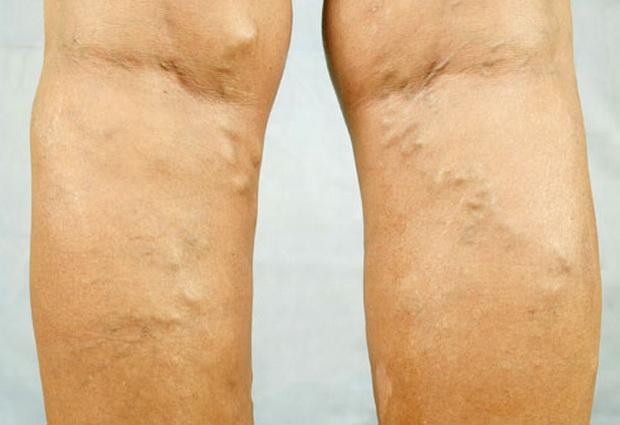 Варикозная экзема – болезнь кожи или болезнь ног?