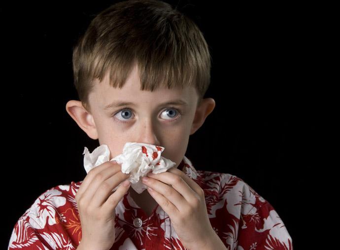 Носовое кровотечение у детей: причины, первая помощь