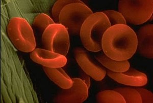 Мегалобластная анемия