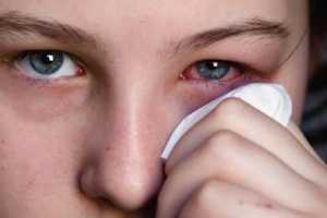 Аллергические заболевания глаз