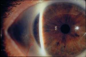 Диагноз: закрытоугольная глаукома