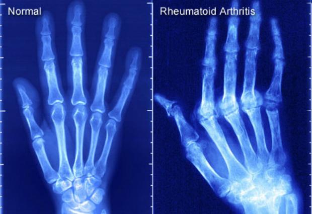 Ученые назвали новые причины развития ревматоидного артрита