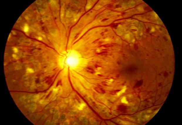 Разработан новый метод лечения ретинопатии с использованием альтернативного ресурса стволовых клеток