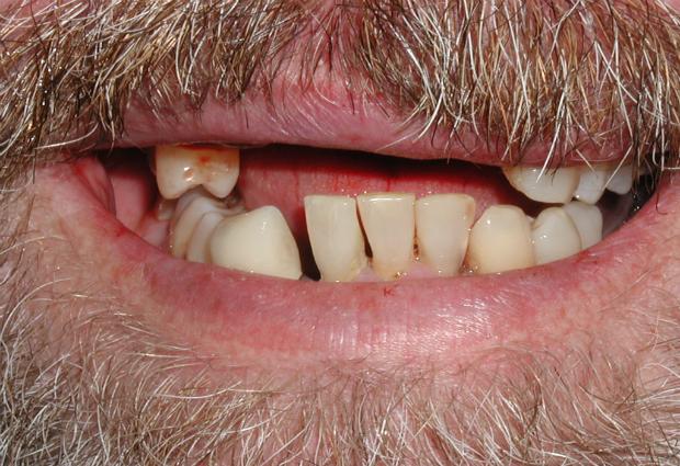 Ученые заявили, что у бедных людей меньше зубов