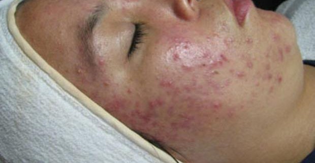 Ученые назвали главную причину кожных заболеваний