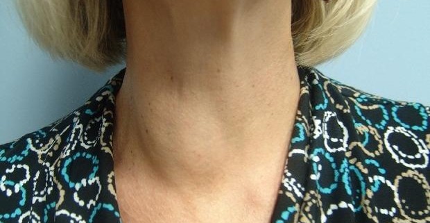 Узлы в щитовидной железе: причины образования, симптомы, осложнения
