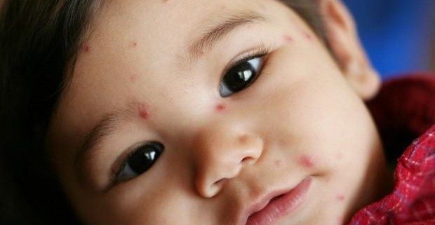 Распространенные дерматологические заболевания у детей. Инфекции и вирусы