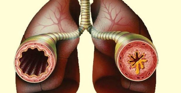 Бронхиальная астма: методы народного лечения