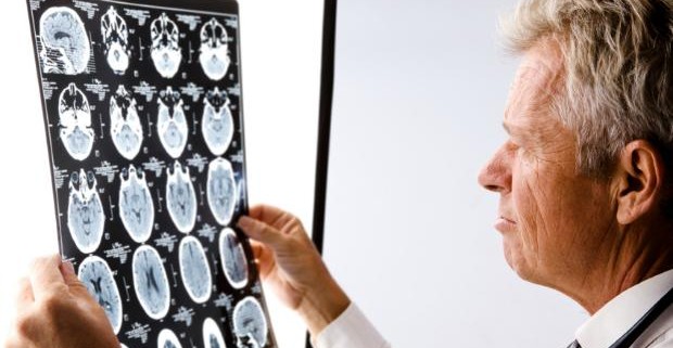 Учеными найден способ защиты мозга от повреждений при инсульте