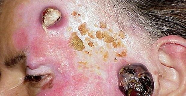Меланома: признаки начинающегося рака кожи