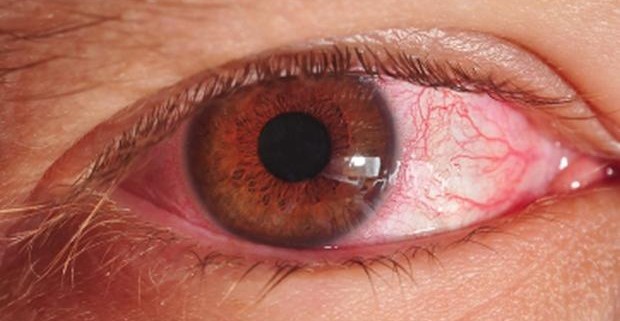 Обнаружен в глазах хламидиоз? Лечение необходимо срочно!