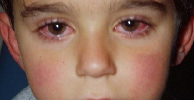 Инфекция хламидиоз у детей: симптомы, методы лечения