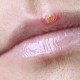 «Простуда» на губах: лечение противовирусное, симптоматическое