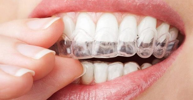 Микроабразия эмали зубов – прогрессивное отбеливание