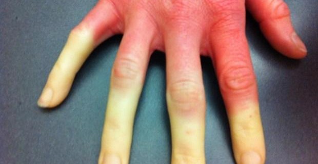 Покалывание пальцев рук: туннельный и кубитальный синдром