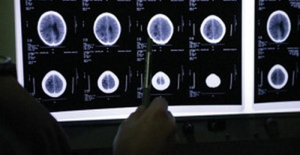 Тяжесть болезни Паркинсона обусловлена воспалением  мозга