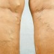 Варикозная экзема – болезнь кожи или болезнь ног?