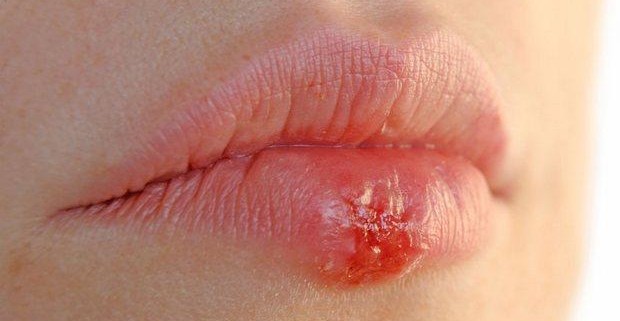 Герпес на губах: лечение мазями