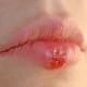 Герпес на губах: лечение мазями