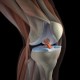 Врачи предупреждают: замена коленного сустава может повлечь за собой набор веса