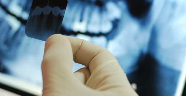 Рентген зубов может стать причиной развития рака мозга