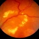 Диабетическая ангиопатия  глазной сетчатки