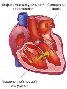 Схема порока сердца
