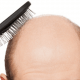 Бесшовная пересадка волос — описание методики