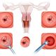 биопсия матки