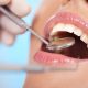 Одноэтапная имплантация зубов: что это такое и как она проходит?