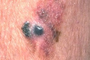 Меланома: признаки начинающегося рака кожи