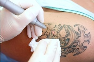 Сведение татуировки