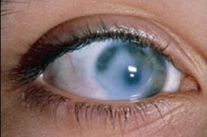 Дистроофия сетчатки глаза