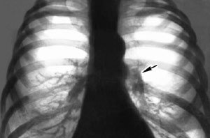 Рентгеновский снимок грудины