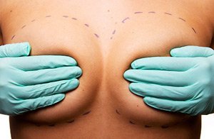 Хирургическое увеличение груди